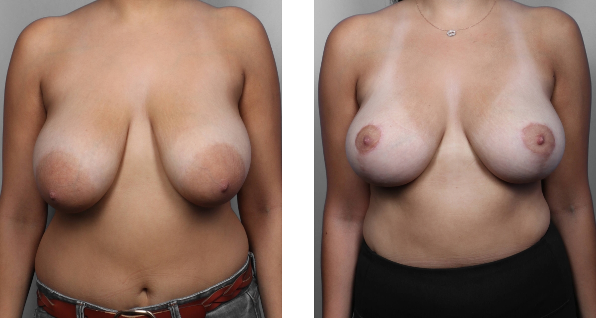 Breast Reduction before & after Patient 8