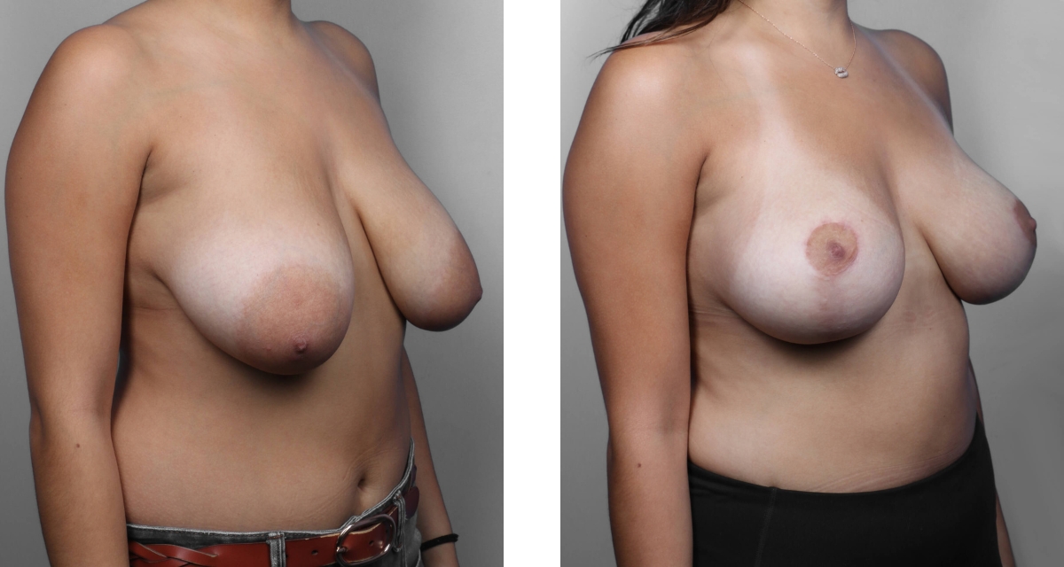 Breast Reduction before & after Patient 8