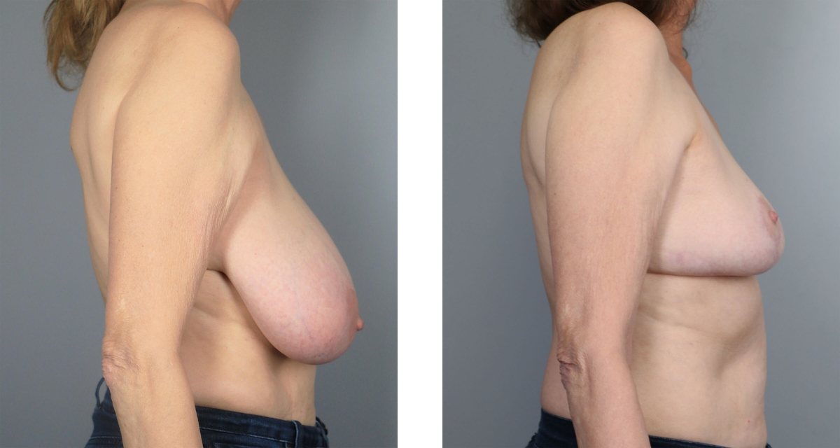Breast Reduction before & after Patient 11