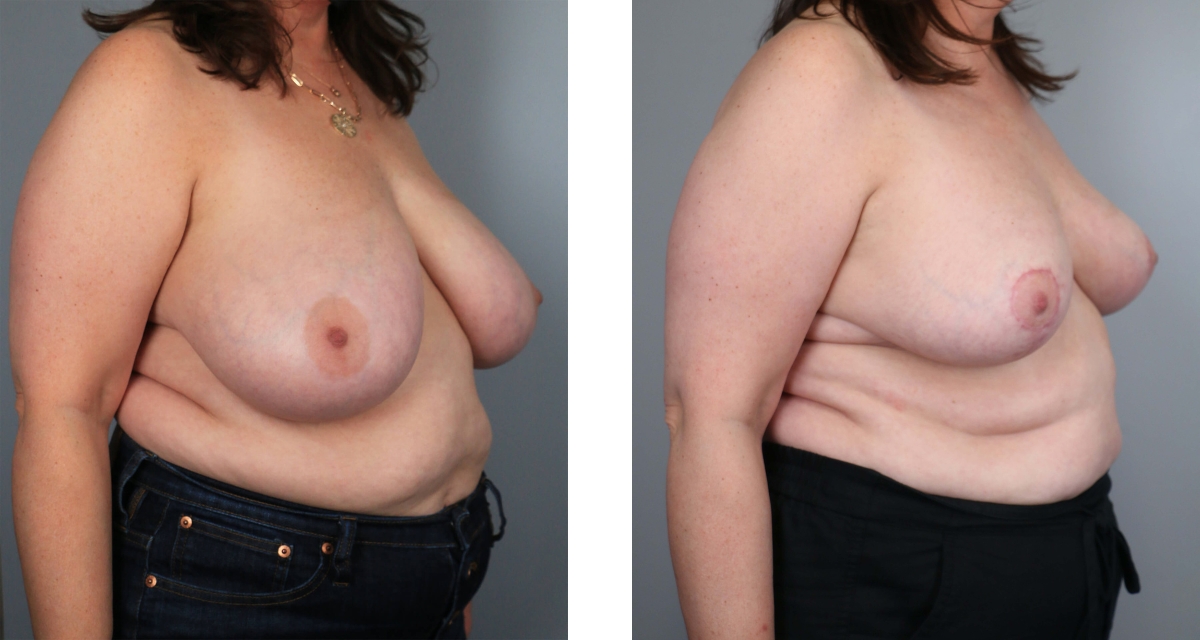 Breast Reduction before & after Patient 12