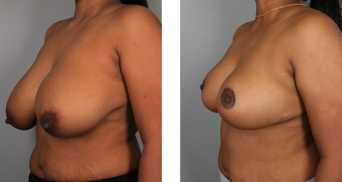 Breast Reduction before & after Patient 13