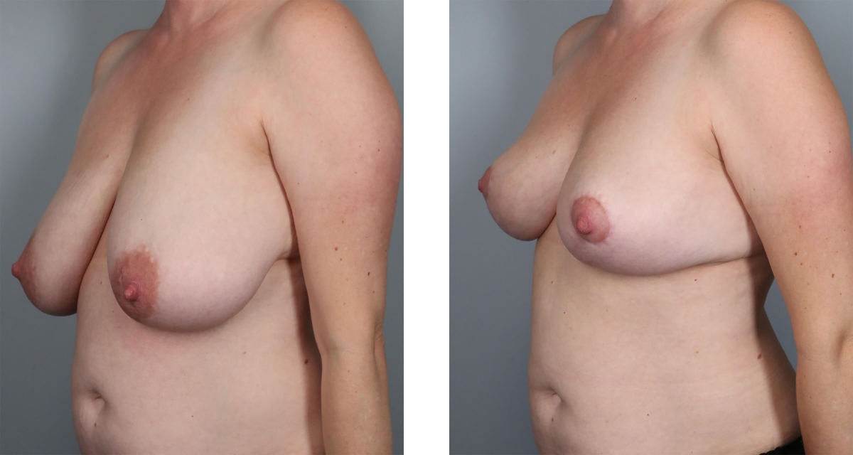 Breast Reduction before & after Patient 14