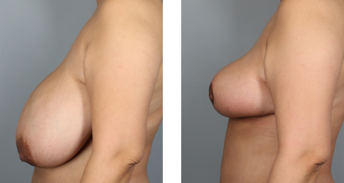 Breast Reduction before & after Patient 16
