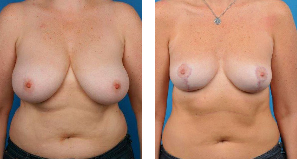 Breast Reduction before & after Patient 2