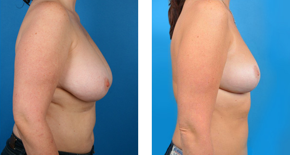 Breast Reduction before & after Patient 2