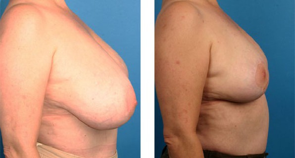 Breast Reduction before & after Patient 4
