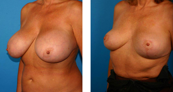 Breast Reduction before & after Patient 5