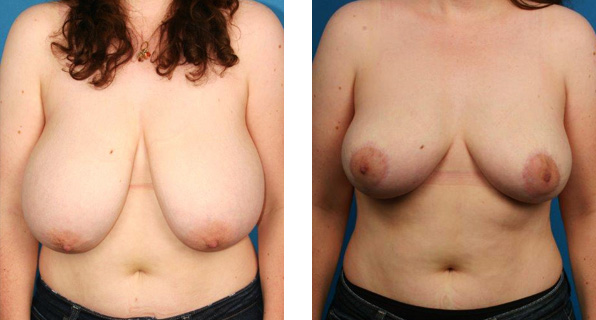 Breast Reduction before & after Patient 6
