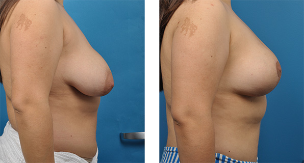 Breast Reduction before & after Patient 7