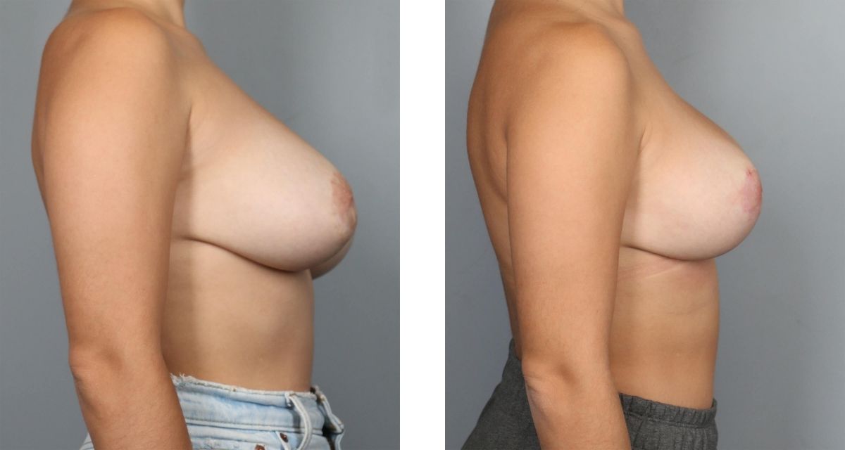 Breast Reduction before & after Patient 39